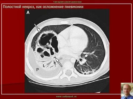 Образования в легких на кт