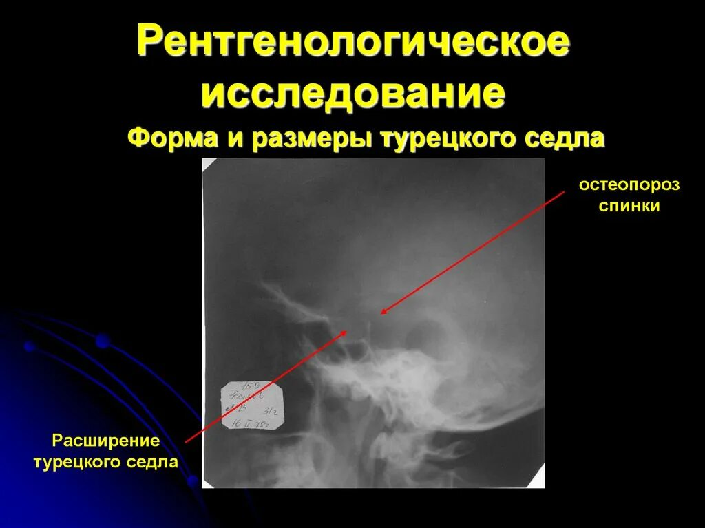 Симптом турецкого седла. Остеопороз спинки турецкого седла рентген. Аденома гипофиза рентген признаки. Остеопороз турецкого седла рентген. Турецкое седло рентген норма.