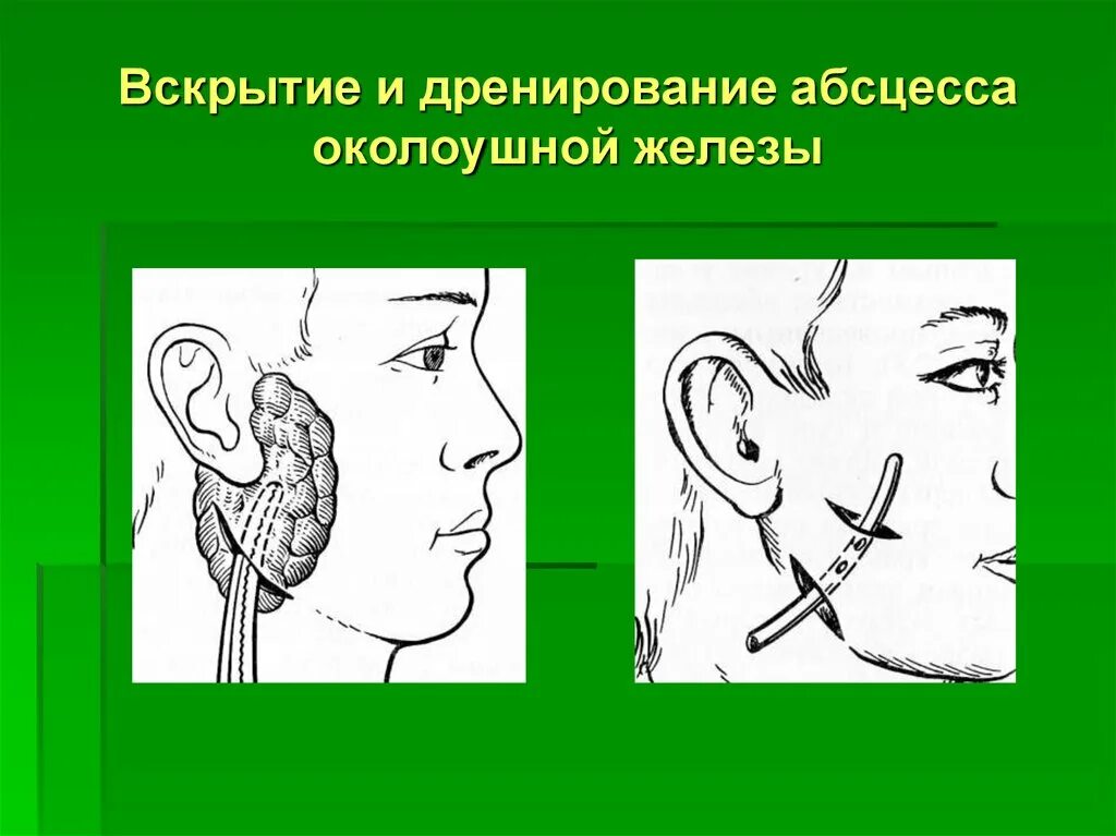 Вскрытие околоушной железы. Вскрытие и дренирование флегмоны. Вскрытие и дренаж абсцесса. Вскрытие абсцесса околоушной. Операции околоушная железа