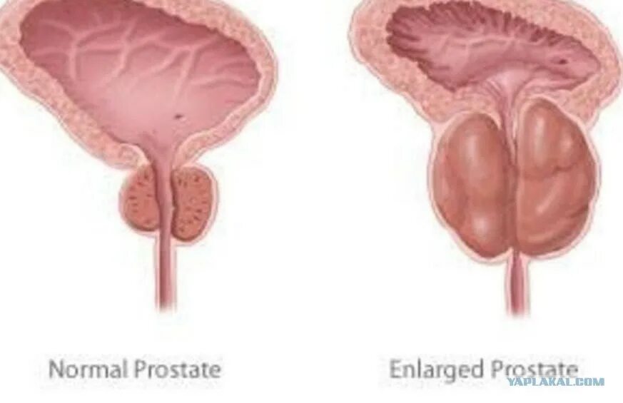 Простатит гиперплазия. Аденома предстательной железы (аденома простаты). Доброкачественная гиперплазия предстательной железы. Аденома доброкачественная гиперплазия. Доброкачественная гиперплазия предстательной железы симптомы.