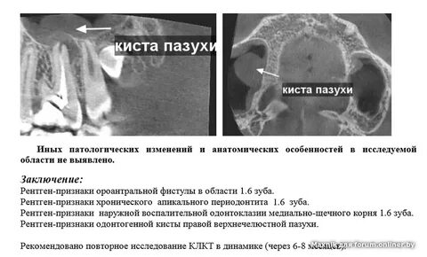 Киста правого верхней челюстной пазухи