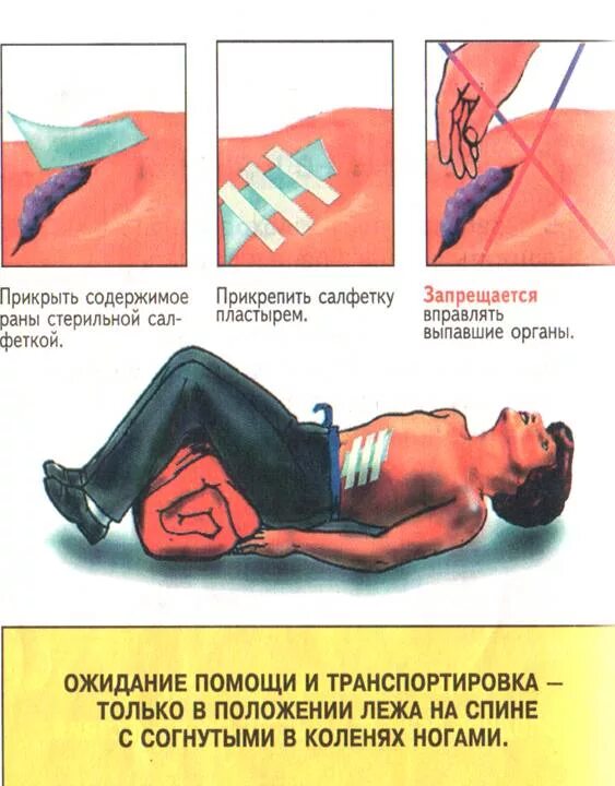 Что запрещается при травме живота. Первая помощь при ранении живота с выпадением внутренних органов. проникающее ранение брюшной полости. первая помощь при огнестрельном ранении в живот. первая помощь при открытой ране живота.