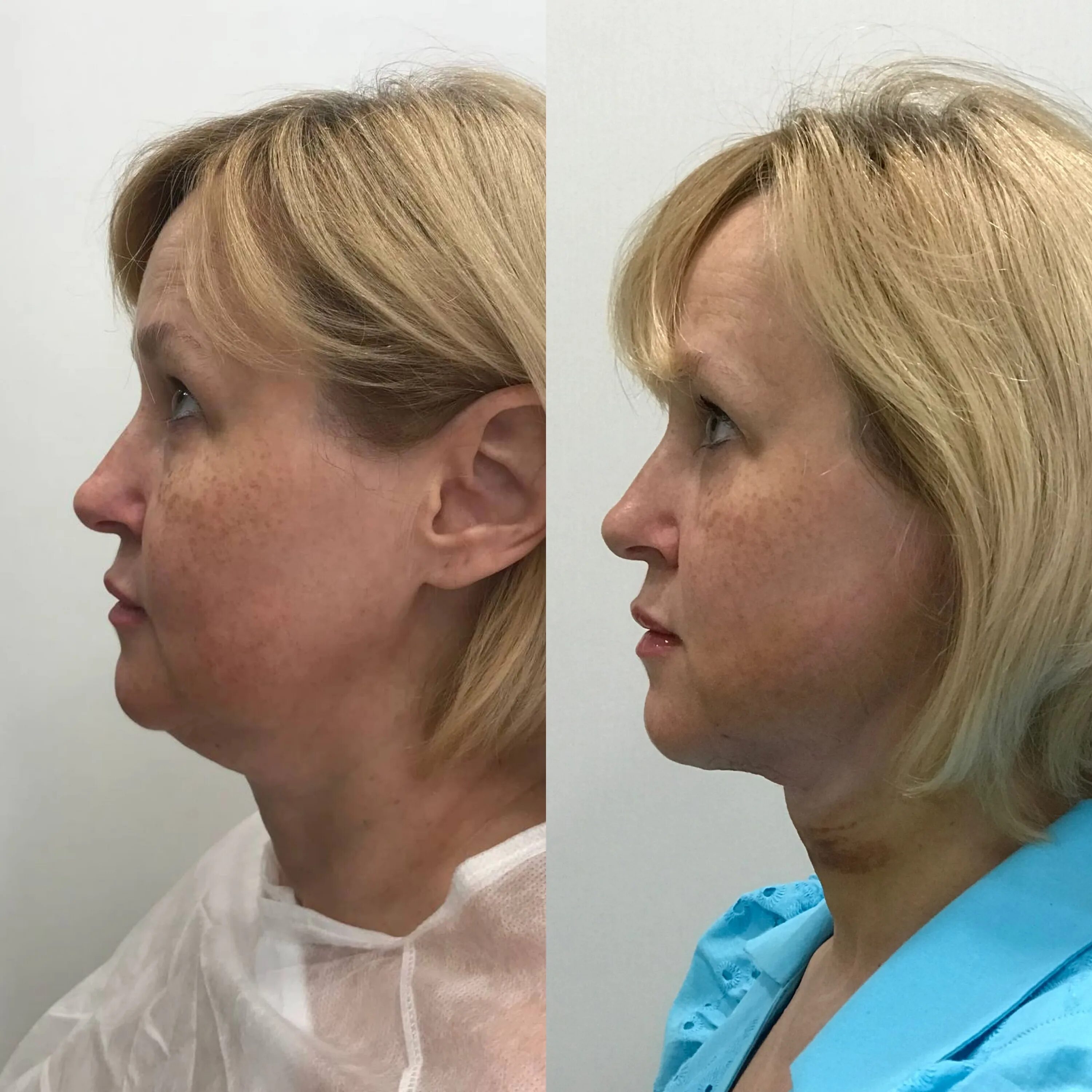 Laser liposuction of the abdomen, chin, face, hips, cheeks, legs, buttocks, arms