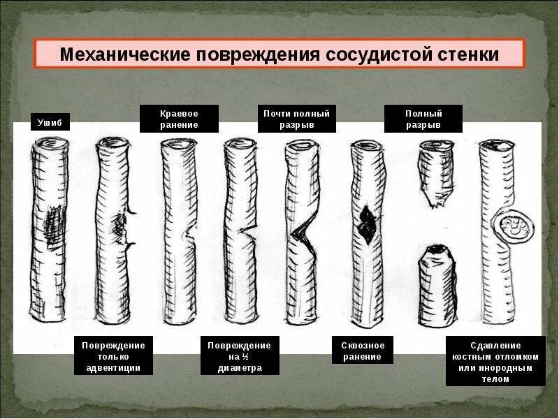 Повреждение сосудистой стенки. Повреждение сосудистой стенки механическое. Механические повреждения, разрыв сосудов. Типы поврежденных сосудов.