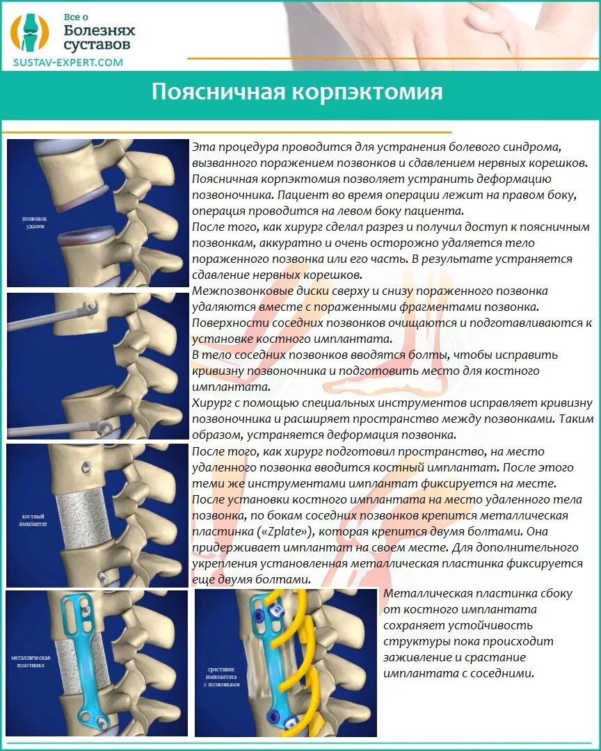 Имплант позвоночника поясничного отдела. Конструкция в позвоночнике. Импланты позвоночника поясничного отдела. Имплант диска шейного отдела позвоночника. Операции на поясничном отделе позвоночника отзывы