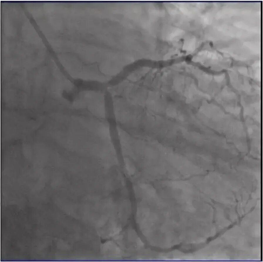 Стентирование передней нисходящей артерии. Стентирование сосудов последствия