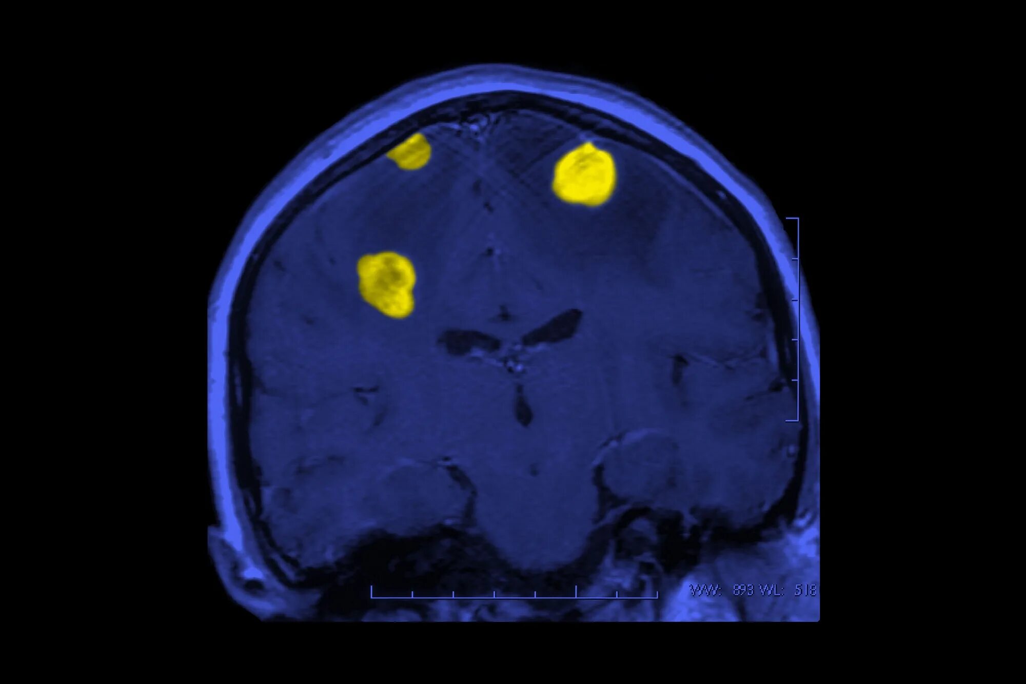 Меланома метастазы в мозг. Опухоль головного мозга снимок. Просовидные метастазы головного мозга. Меланома на кт головного мозга.