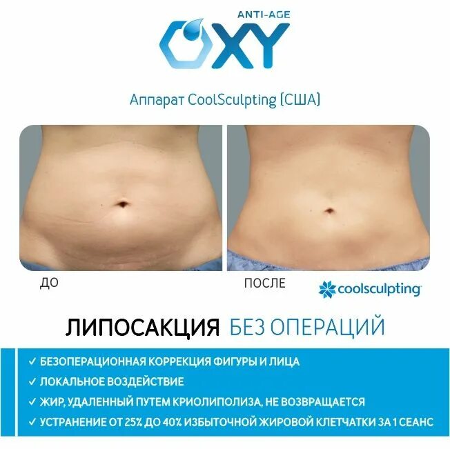 Криолиполиз кемерово. Криолиполиз. рекомендации до и после криолиполиза.