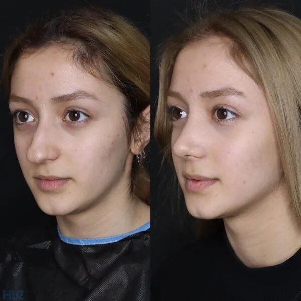 Подростковый нос. Ринопластика до и после. широкий нос пластика. широкий нос у девушек.