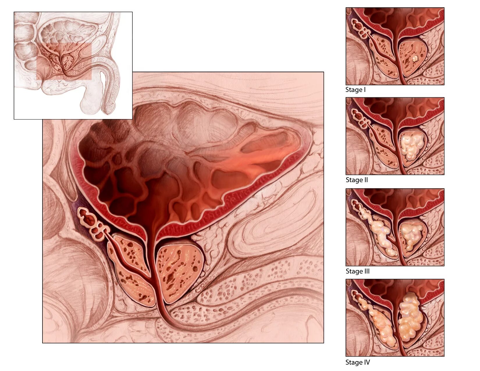 Доброкачественной гиперплазией предстательной железы у мужчин. Аденома предстательной железы. Простатит, аденома предстательной железы. Аденома карцинома предстательной железы. Доброкачественная гиперплазия предстательной железы.