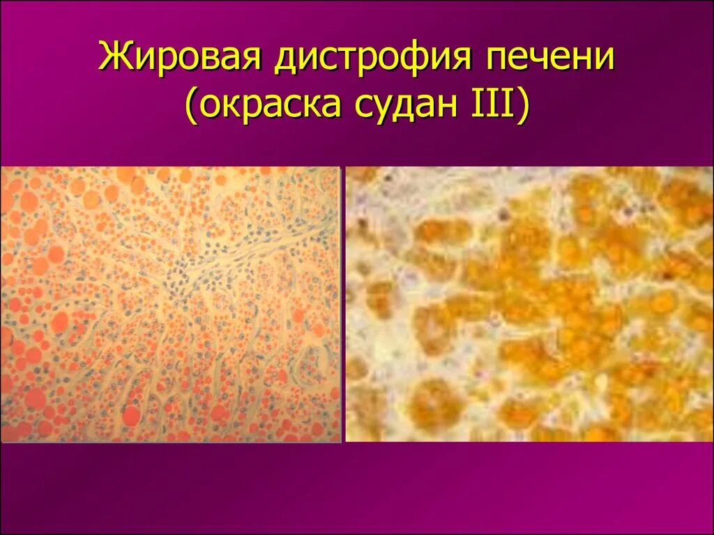 Дистрофия печени причины. Жировая паренхиматозная дистрофия печени Судан 3. Стеатоз печени микропрепарат Судан 3. Жировая паренхиматозная дистрофия печени макропрепарат. Жировая инфильтрация печени Судан 3.