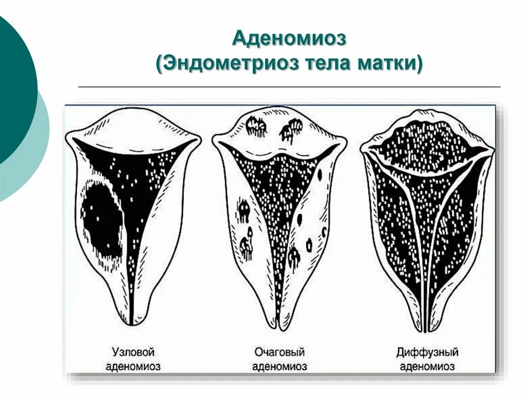 Аденомиоз и эндометриоз. Очаговая форма эндометриоза тела матки. Аденомиоз патология матки.