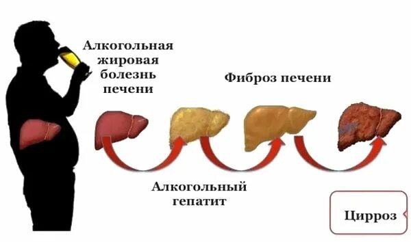 Жировой гепатоз печени гистология. Цирроз печени строение. Алкогольный фиброз. Алкогольный цирроз печени гистология. Алкогольный стеатогепатит.