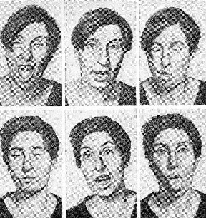 Хорея хантингтона. Болезнь хорея гентингтона. хорея хантингтона (гентингтона). болезнь гентингтона (хантингтона). хорея гентингтона клинические проявления.