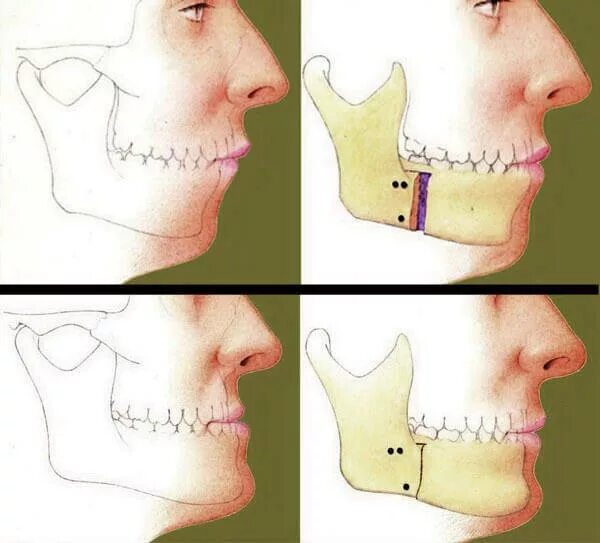 Остеотомия челюсти операция. Ортогнатическая операция мезиальный прикус. Ортогнатическая операция мезиальный прикус. Ортогнатическая хирургия мезиальный прикус. Операция члх прикус исправление.