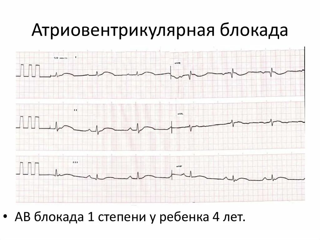 Полная атриовентрикулярная блокада. Атриовентрикулярная блокада причины. Причины атриовентрикулярной блокады. Внутрижелудочковые блокады на ЭКГ рекомендации. ДК атриовентрикулярная блокада.