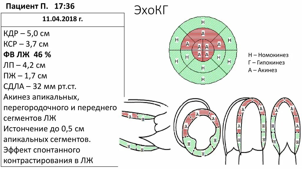 Гипокинез передних сегментов