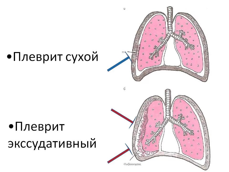 Заболевание сухие легкие. Фибринозный сухой плеврит патогенез. Сухой туберкулезный плеврит. Сухой и эксцдативныйплеврит. Сухой и экссудативный плеврит.