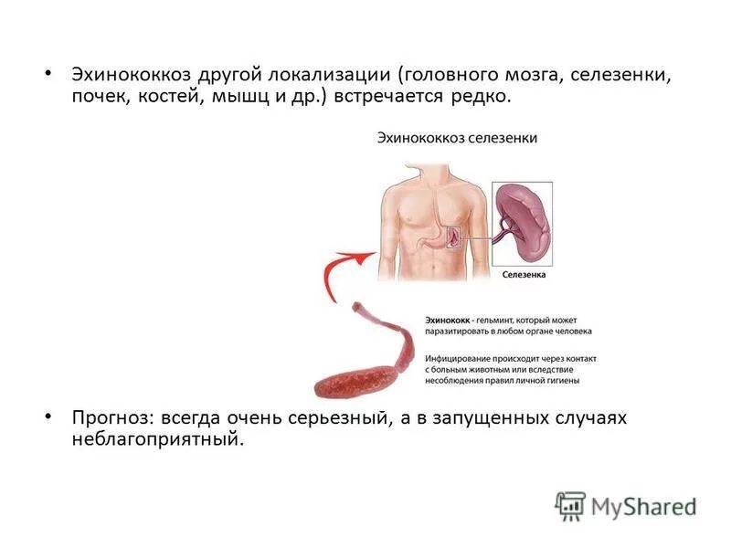 Эхинококковая киста печени кт. Эхинококкоз материал для исследования. Исследование эхинококкоз. Профилактика эхинококкоза. Исследование эхинококкоз.
