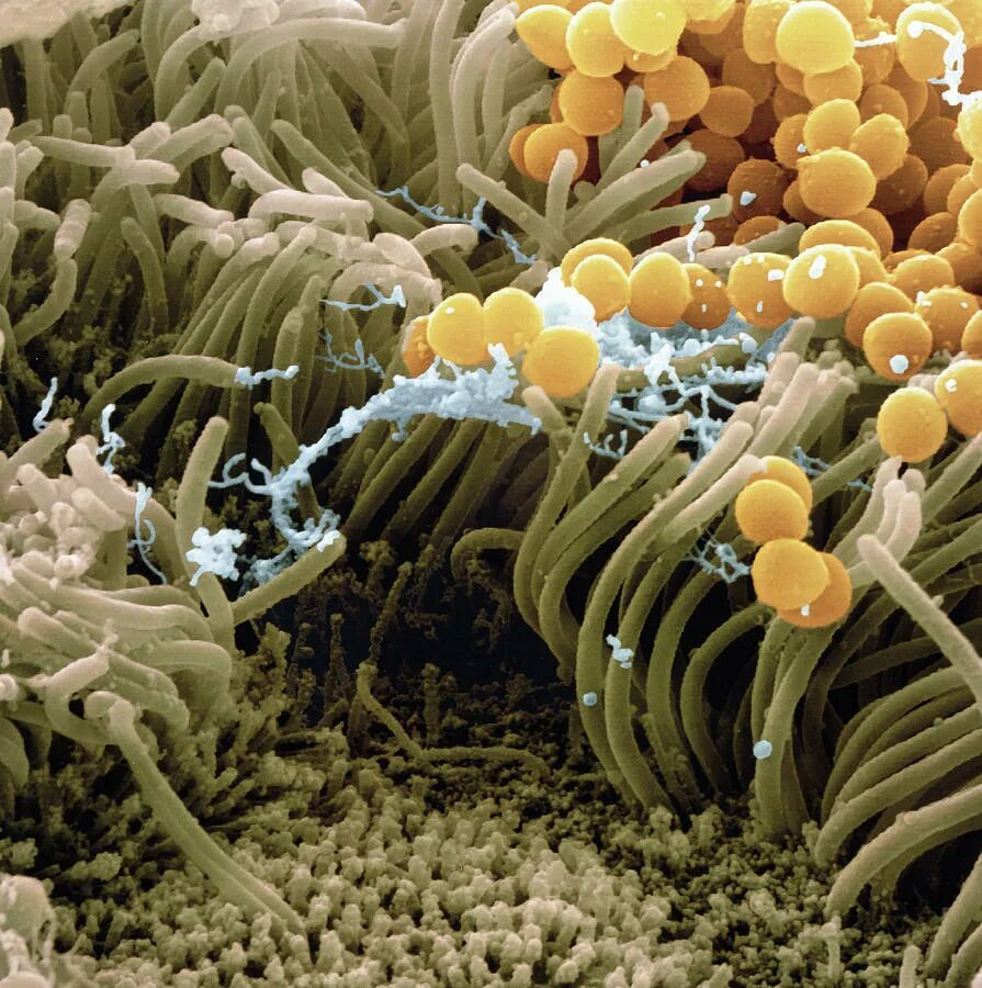 Staphylococcus epidermidis что это. Staphylococcus epidermidis что это