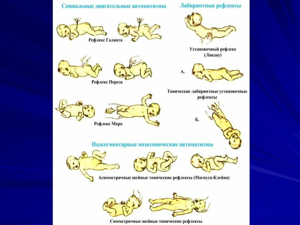 Лабиринтный установочный рефлекс у детей. Рефлексы спинального АВТОМАТИЗМА У детей. Верхний рефлекс Ландау. Установочные рефлексы у детей.