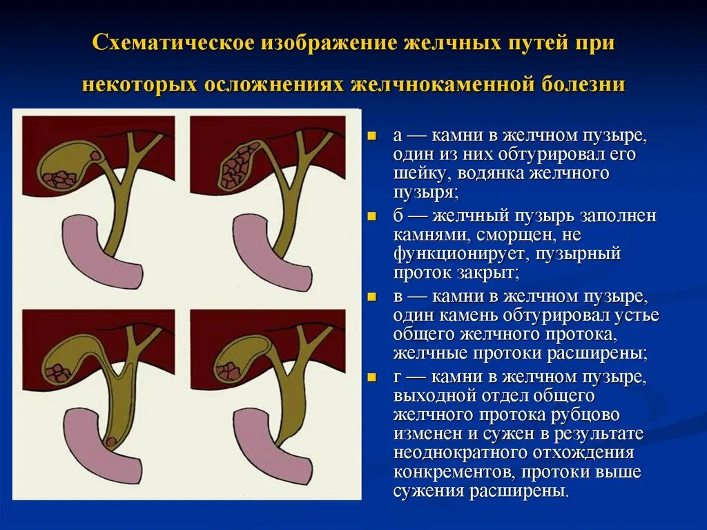 Холецистолитиаз желчного. Желчекаменная болезнь презентация. Желчнокаменная болезнь презентация. Желчнокаменная болезнь пре. Холецистит и ЖКБ презентация.