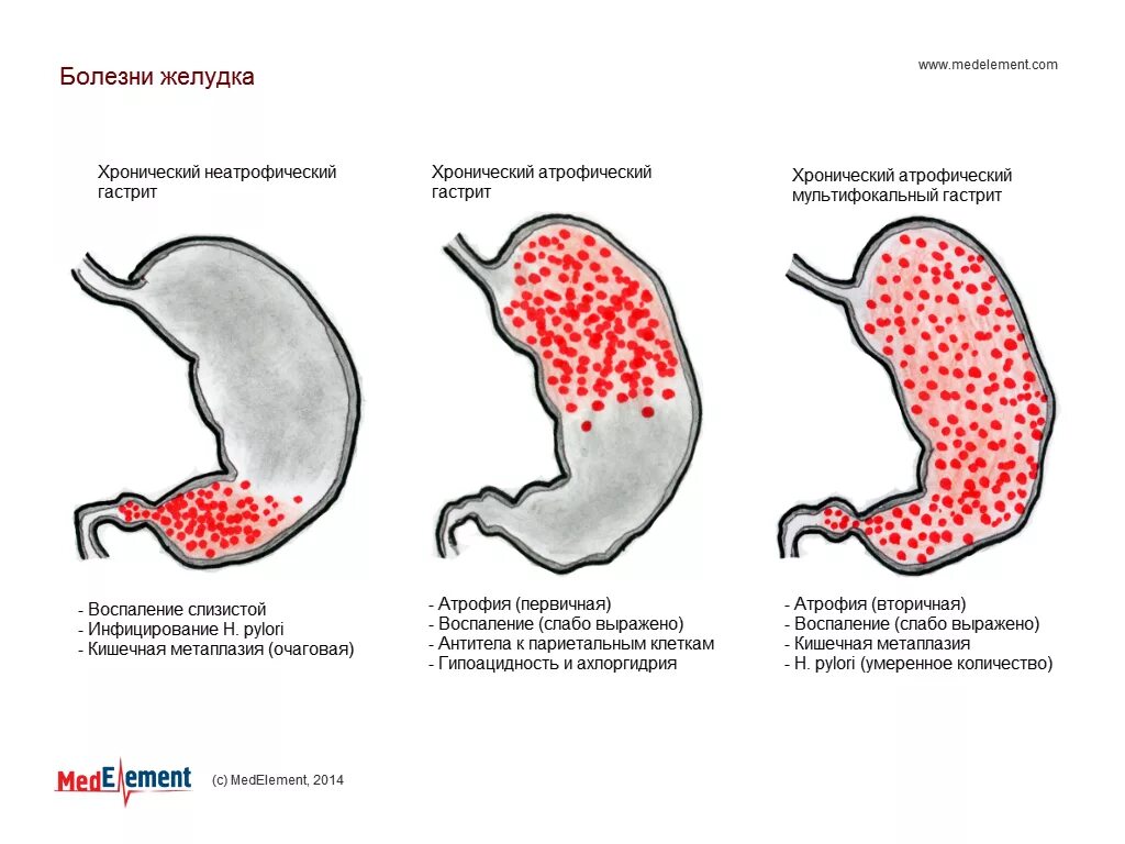 Как восстановить слизистую при гастрите. Поражение слизистой оболочки желудка с воспалительными изменениями.. Хронический атрофический гастрит синдромы. Хронический неатрофический гастрит симптомы. Хронический неатрофический очаговый гастрит.