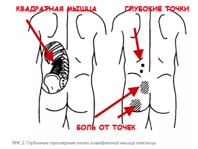 Болит спина отдает в ягодицу. Квадратная мышца поясницы триггерные точки. Триггерные точки при болях в пояснице. Триггера в квадратной мышце поясницы. Квадратная мышца поясницы болит.