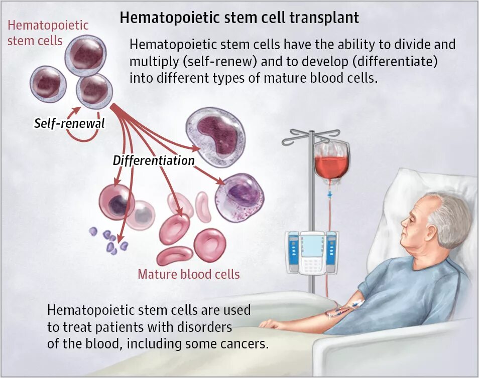Пересадка клеток мозга. Трансплантация кроветворных стволовых клеток. Стволовые клетки костного мозга. Аутологичные стволовые клетки. Аутологичная трансплантация гемопоэтических стволовых клеток.