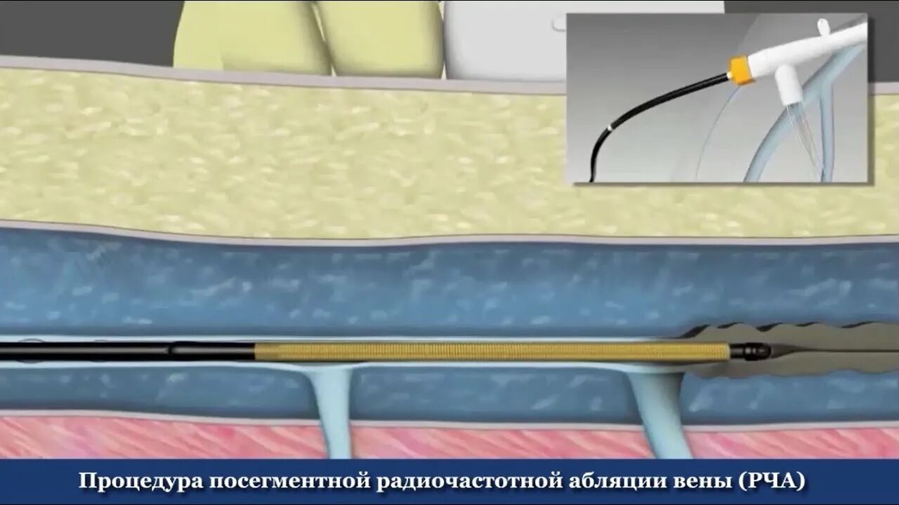 Сколько лежать после рча. Рча вен нижних конечностей. радиочастотная абляция варикозных вен. радиочастотная абляция вен нижней конечности.