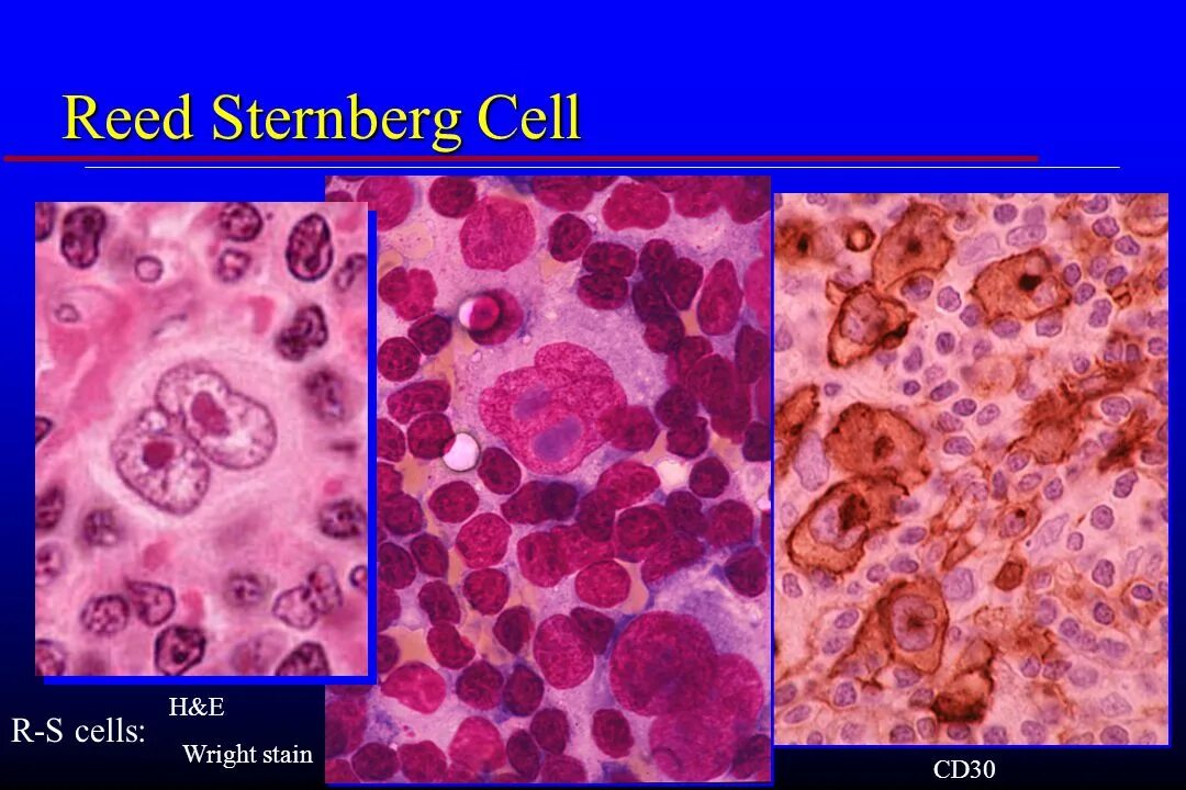 Рид штернберга. Клетки Рид-Березовского-Штернберга. Многоядерные клетки Березовского-Рид-Штернберга. Клетки Ходжкина и Рид-Штернберга. Клетки Березовского-Штернберга гистология.