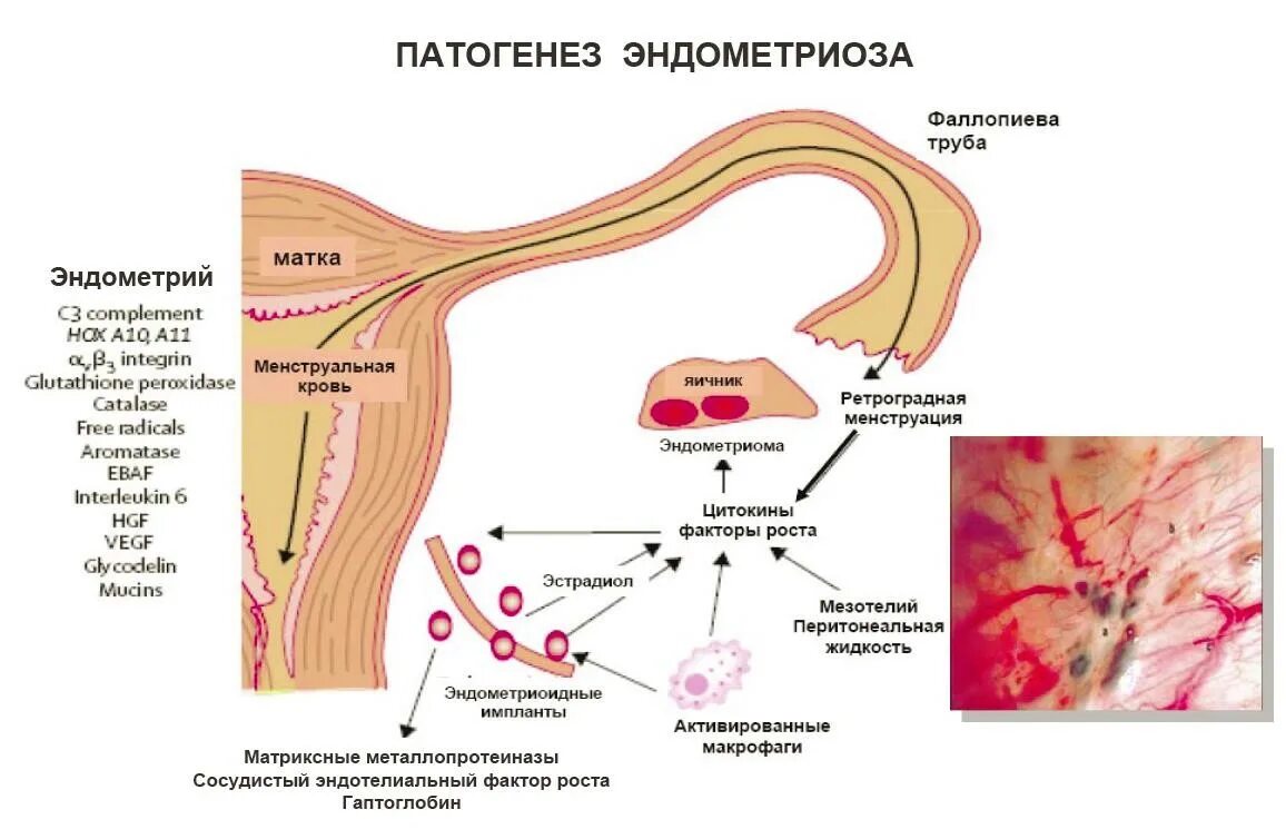 Норма эндометриоза. Ретроцервикальный эндометриоз патогенез. Механизм развития эндометриоза. Патогенез наружного генитального эндометриоза. Этиология внутреннего эндометриоза.