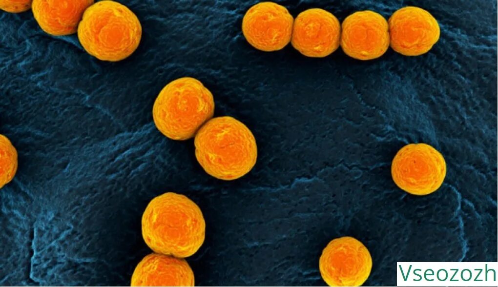 У ребенка стафилококк золотистый 10. S. aureus золотистый стафилококк. Пузырчатка стафилококк. Поражение кожи золотым стафилококком. Золотистый стафилококк кал.