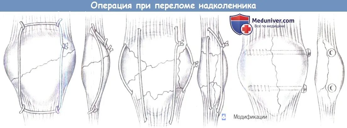 Кисетный шов перелома надколенника. Операции при переломе надколенника по Веберу. Остеосинтез надколенника по Веберу. Остеосинтез надколенника операция. Перелом надколенника операции