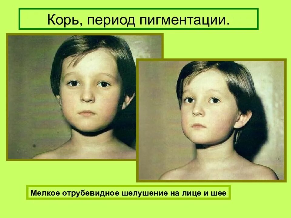 Иммунизация детей. Корь! undefined