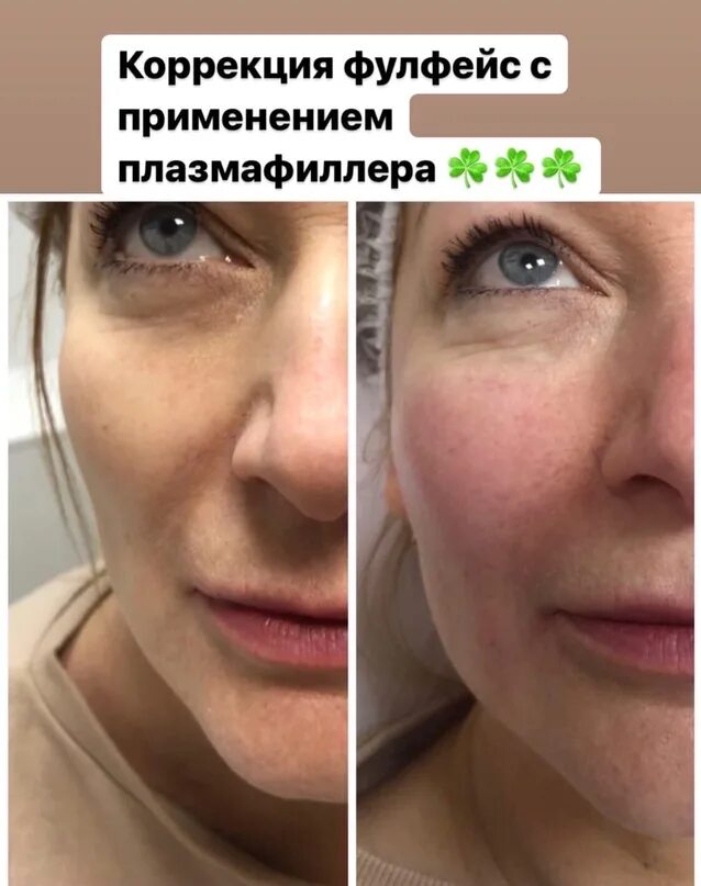 Плазмогель для губ фото до и после. Плазмогель для лица отзывы. Плазмогель для лица отзывы. Плазмогель для лица отзывы. Плазмогель для лица отзывы.