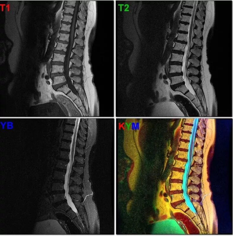 Мрт спинного отдела. Мрт грудного отдела позвоночника. Остеохондроз поясничного крестцового отдела на мрт. Мрт позвоночника th12-s3. Мрт грудного отдела и пояснично крестцового отдела.