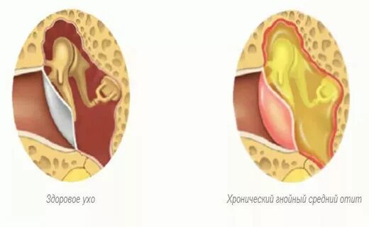 Гной экссудативный отит. Хронический Гнойный отит. Двусторонний катаральный средний отит. Двусторонний острый Гнойный средний отит.