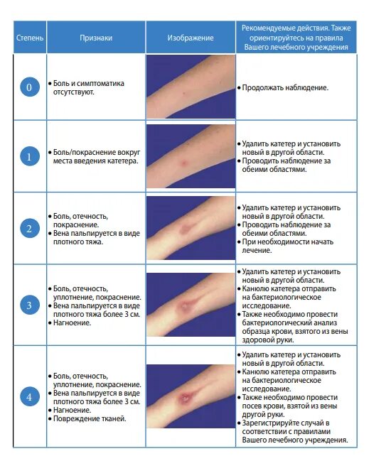 Почему после катетера. Схема постановки периферического катетера. Шкала оценки флебита. Введение периферического катетера алгоритм. Периферический катетер уход алгоритм.