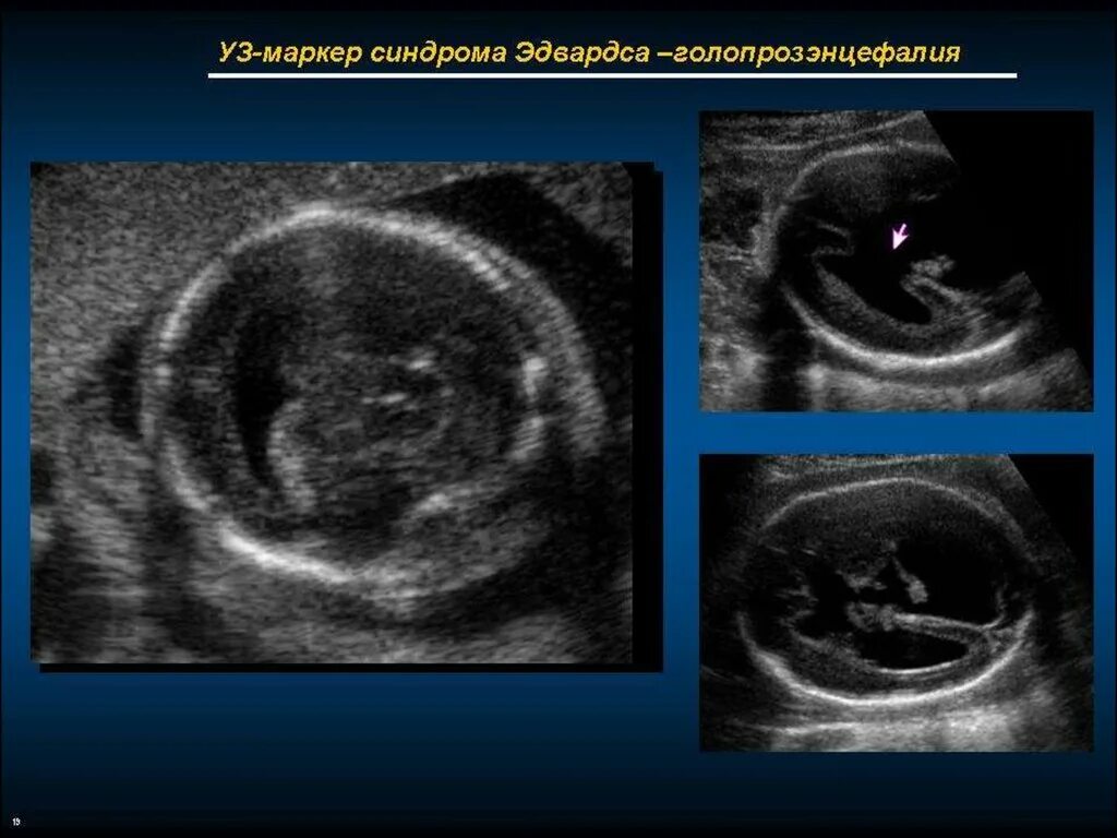 Узи аномалий. Синдром Эдвардса УЗИ 1 скрининг. Синдром Патау на УЗИ 1 скрининг. Синдром Патау УЗИ диагностика. УЗИ ребенка с синдром Патау.