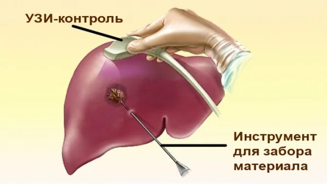Биопсия печени после биопсии. Тонкоигольная биопсия печени. Чрескожная биопсия печени. Чрескожная пункционная биопсия печени. УЗИ И взятие биопсии печени.