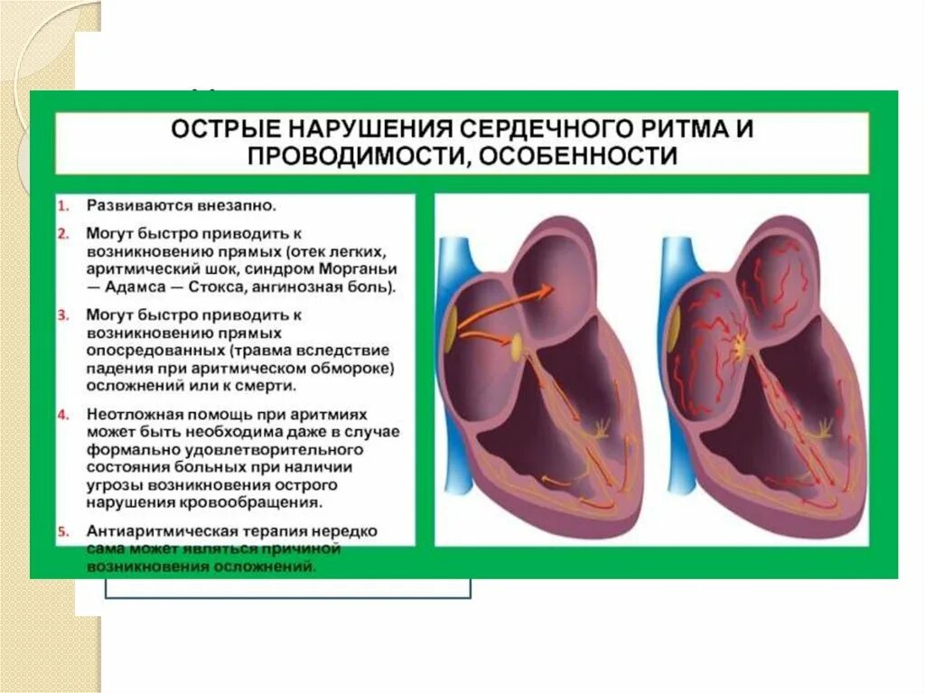 Острое сердечное нарушение. Нарушение ритма и проводимости сердца. Синдром нарушения сердечного ритма пропедевтика. Нарушение сердечного ритма и проводимости клиника. Нарушение ритма и проводимости сердца причины.