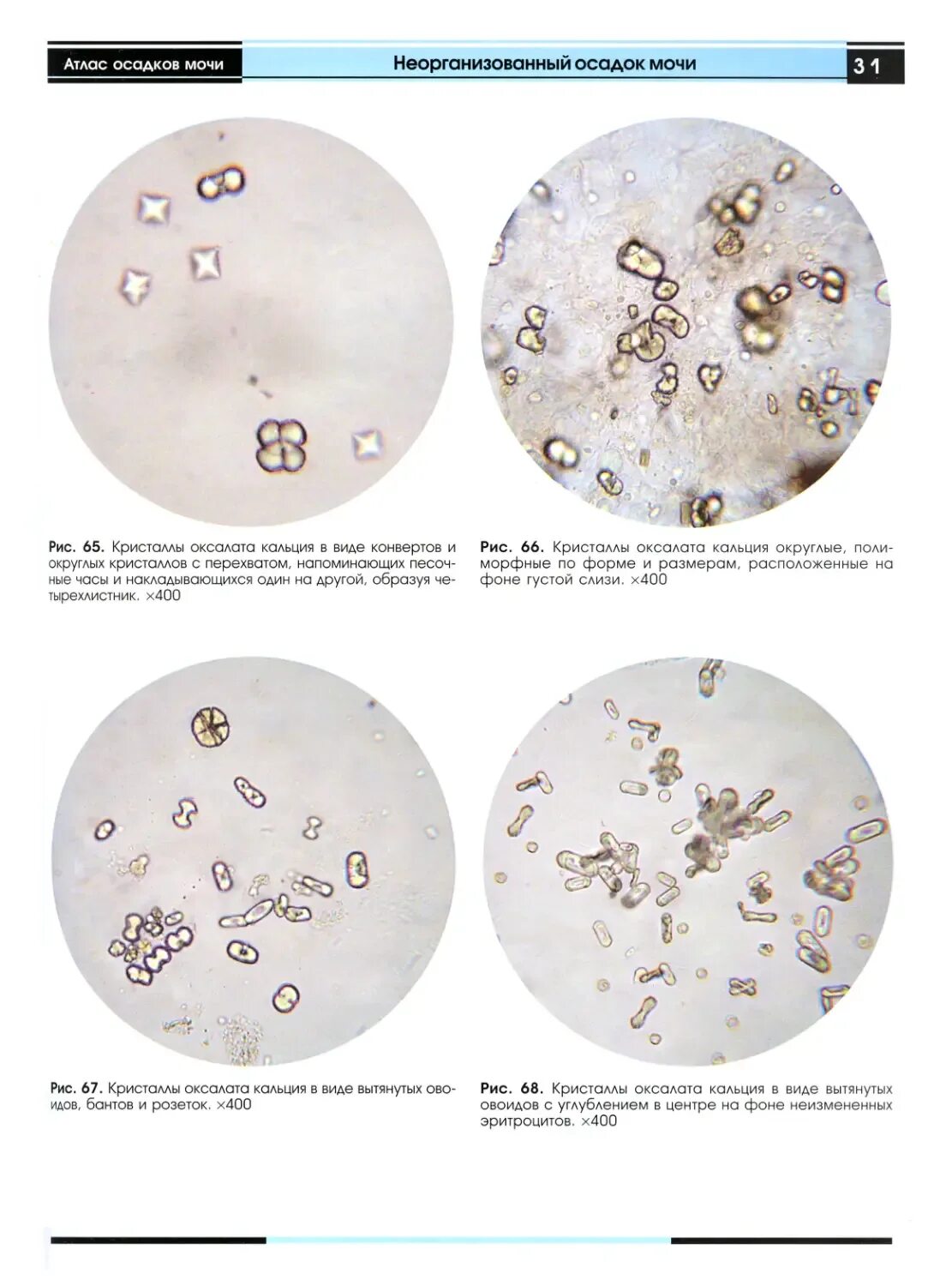 Микроскопия осадка мочи. Микроскопия осадка мочи атлас. Кристаллы оксалаты в моче. Кристаллы в моче под микроскопом.