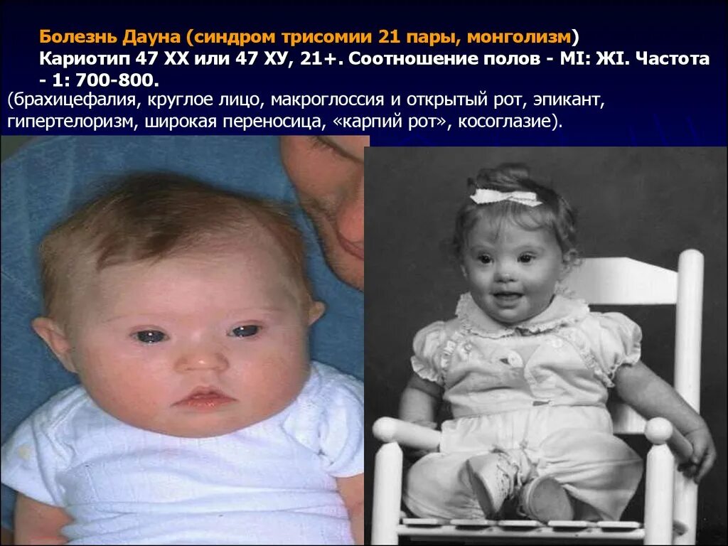 Синдром пола. Синдром дауна макроглоссия. монголизм. болезнь дауна..