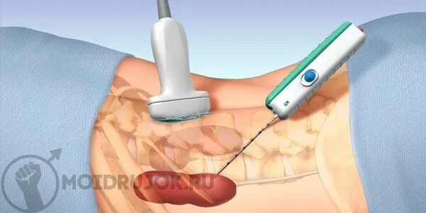 Как берут биопсию у мужчин. Трепан биопсия молочной железы. Чрескожная биопсия почки. Трепан биопсия брюшной полости. Тонкоигольная биопсия молочной железы.