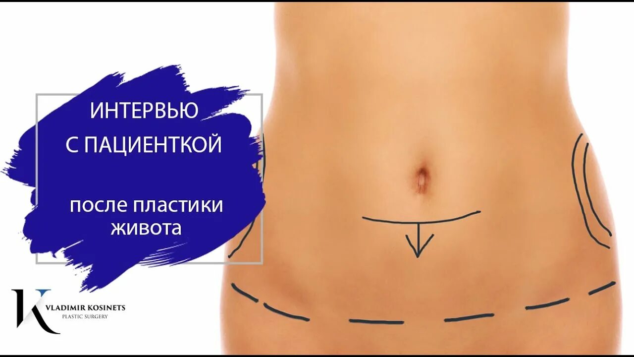 Липосакция в Клинике Максима Рослякова