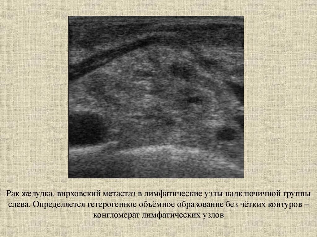 Конгломерат лимфатических узлов на УЗИ. Конгломерат лимфоузлов на УЗИ. УЗИ заушных лимфатических узлов. Метастатические лимфоузлы