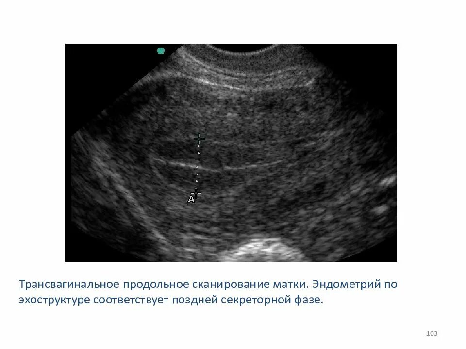 Увеличенная эндометрия матки. Десквамация эндометрия УЗИ. Измерение толщины эндометрия на УЗИ. Норма эндометрия на УЗИ. Структура эндометрия на УЗИ.