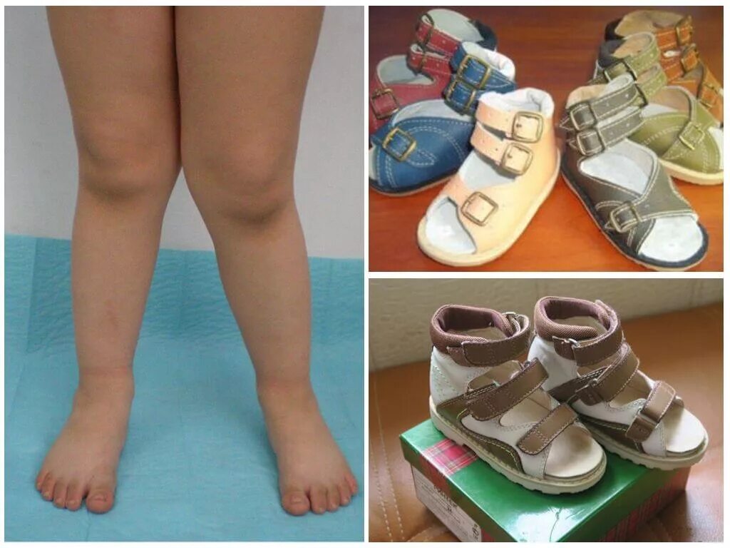 Ортопедическая обувь для вальгусной стопы. Ортопедическая обувь для детей при плосковальгусной деформации стоп. Обувь при вальгусной деформации стопы у детей 1 год. Ортопедическая обувь при вальгусной деформации стоп для женщин. Ортопедические стельки Варус вальгус.