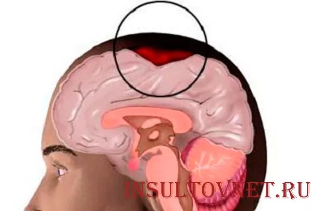 Воспаление головного мозга. Кровоизлияние в головной мозг.